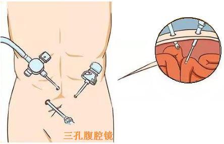 什么是单孔腹腔镜腹股沟疝修补术?有何优势?