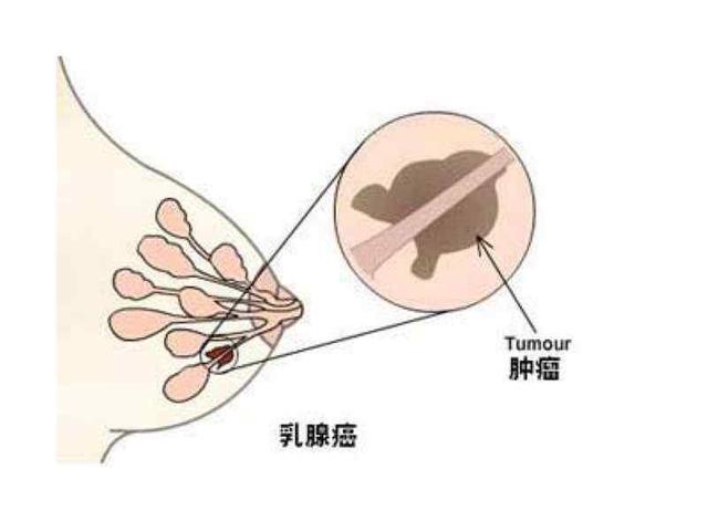 乳腺中发现新型免疫细胞,可以重塑乳房,防止乳腺癌