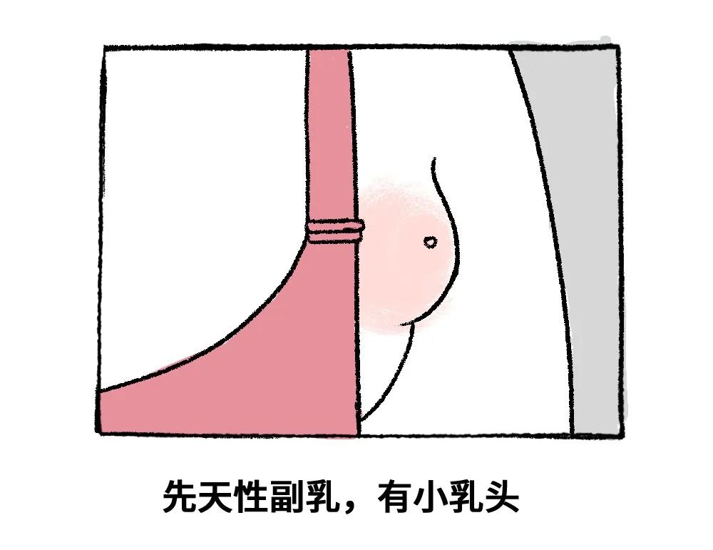 先天性副乳 一般在腋前或者腋下 也有发生在胸部正常乳房的上下 腹部