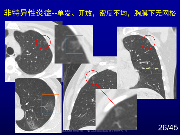 赵振军:最全图文解读《新冠肺炎ct早期诊断和鉴别诊断(中)