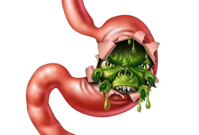 幽门螺杆菌病是唯一能在胃中生存的一种细菌.