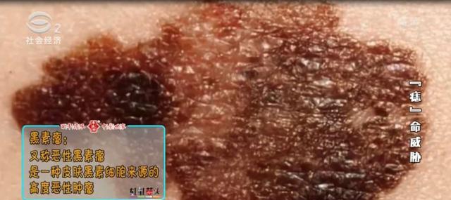 "痣"命威胁,它可能是黑色素瘤!这些症状请小心