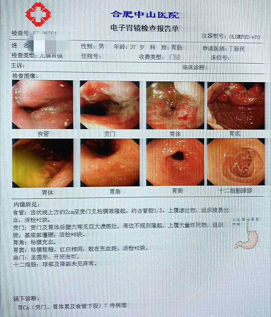 体检中永远不可忽视的项目——胃肠镜