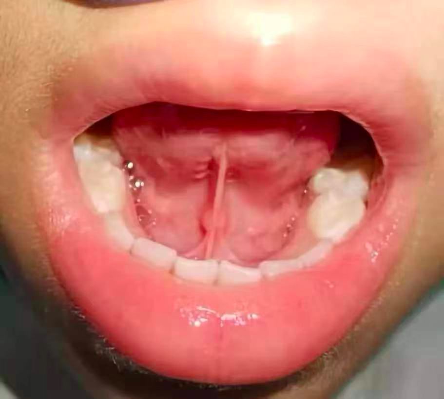 当我们向上伸舌头的时候,就能看到舌下方绷紧的条索状组织.