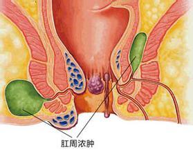 肛周脓肿主要发生在肛门周围,肛周脓肿会出现肛门长包,肛门疼痛,全身