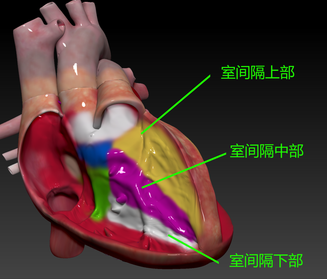图4. 室间隔上缘,前室间隔和后室间隔的解剖示意图. 图5.