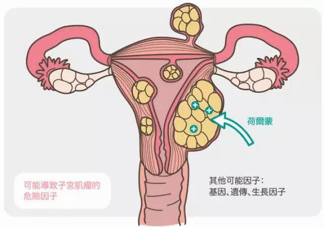 浆膜下子宫肌瘤的影响很弱,其次是肌壁间肌瘤,紧密的是粘膜下肌瘤