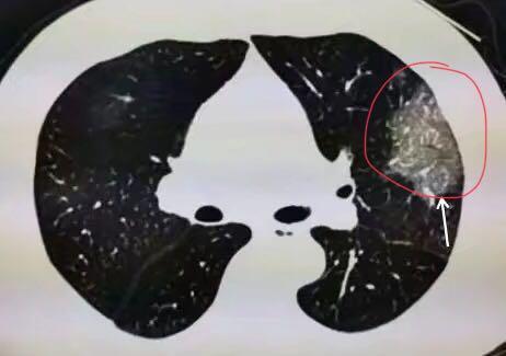 新冠肺炎患者肺部ct显示磨玻璃影(图片来自网络)