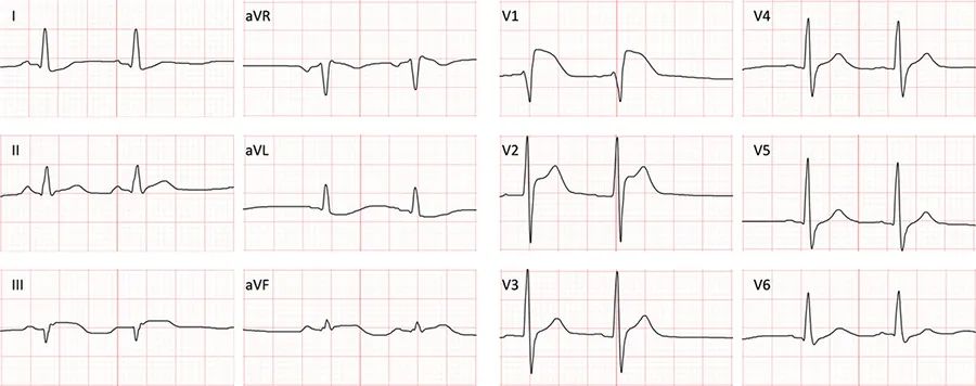 干货丨快速判别右室梗死心电图有哪些特殊表现