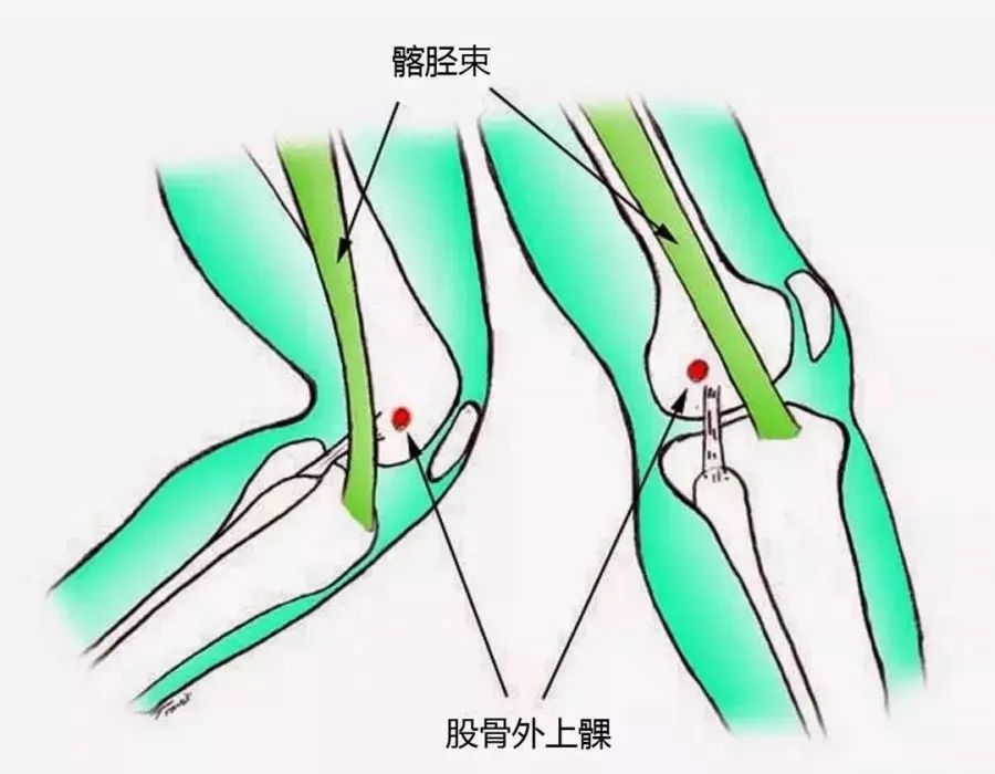 干货丨跑者,别总等中招后才了解髂胫束的厉害