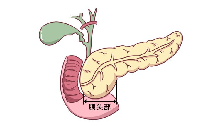 正文这年头 加班狗谁还没个腰酸背痛 但胰腺癌的症状也可能是这个