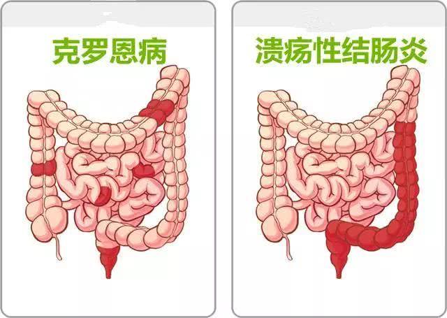 安倍晋三黯然交出日本相位,溃疡性大肠炎就这么不好惹?__凤凰网