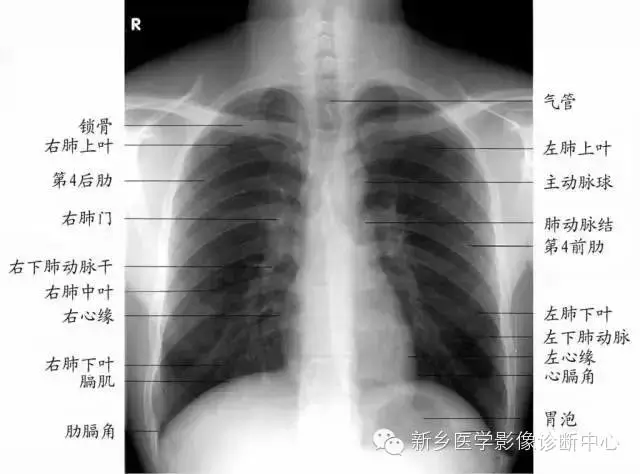 5,判断病灶来自肺内还是胸膜腔在x线胸片中