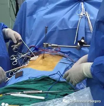 心脏外科手术可以微创吗?