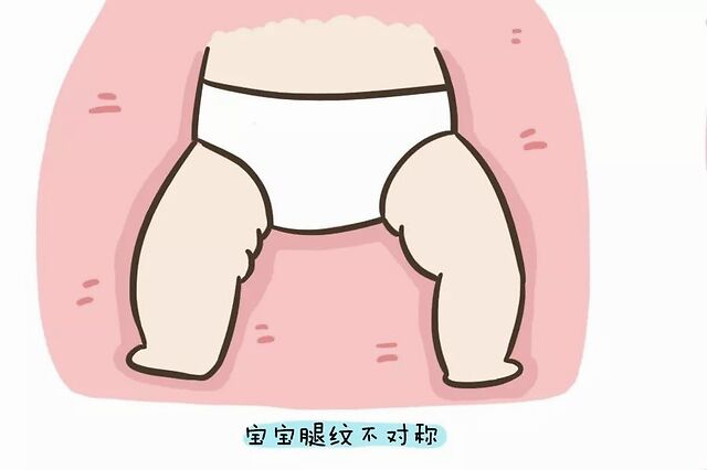 腿纹/臀纹不对称就是髋关节发育有问题?学会自查方法