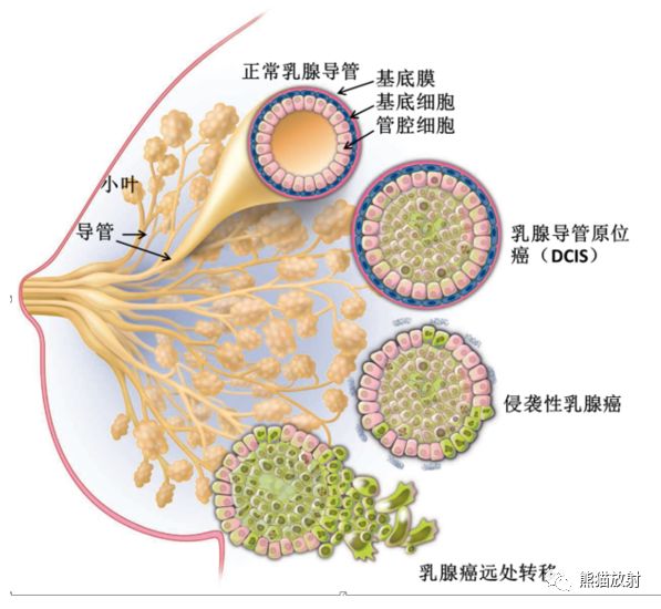 1,乳头,2,输乳管及乳腺导管,3,皮肤,4,脂肪岛,5,cooper"s韧带,6,静脉