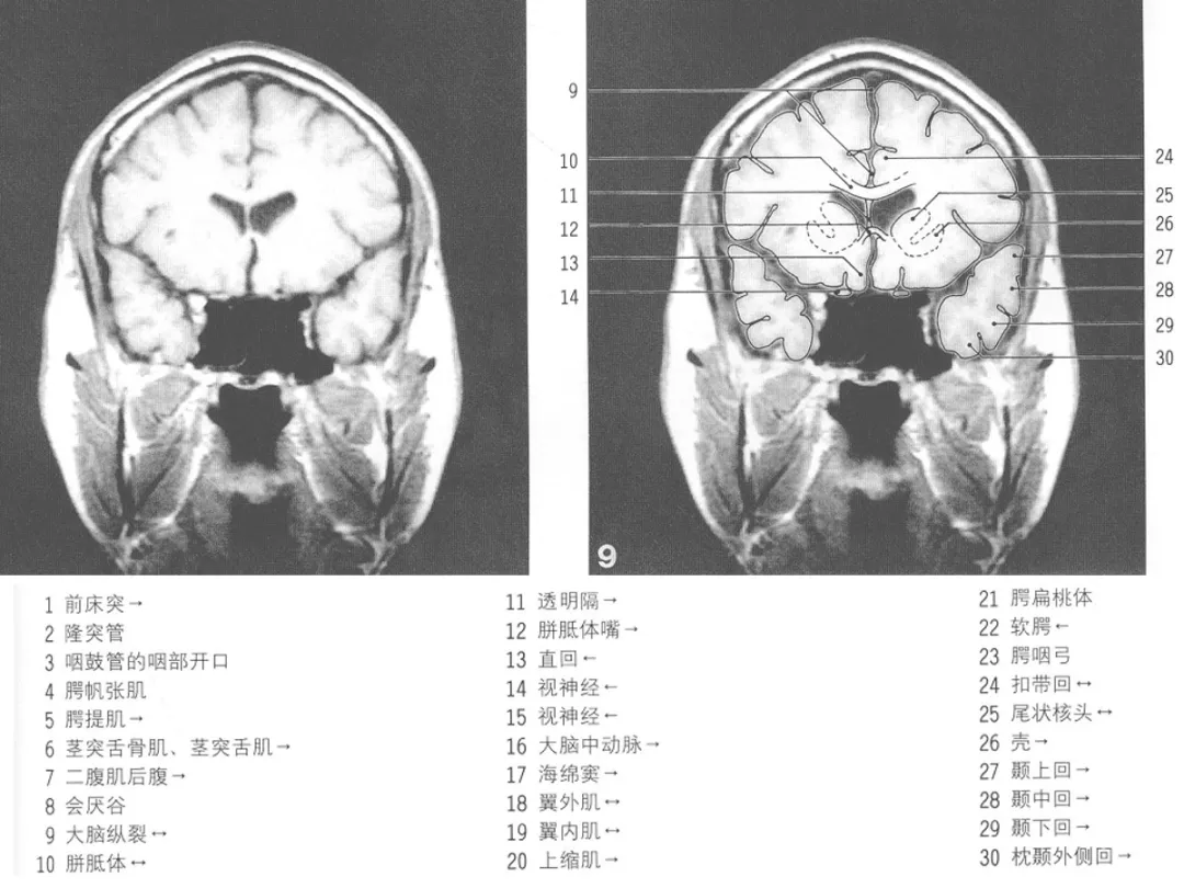 影像基础mri颅脑冠状位解剖图谱