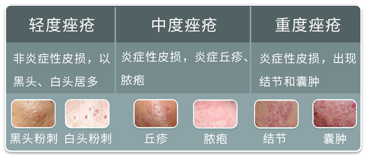 按严重程度将其分为3种《中国痤疮治疗指南》首先得知道痘痘的类型