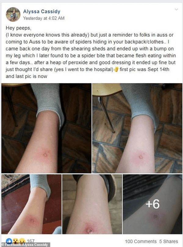 22岁女子来澳洲旅游被蜘蛛咬伤,医院检查吓一跳:轻则残疾,重则丢命