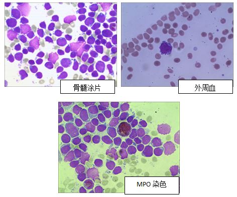 骨髓常规示:有核细胞增生极度活跃,粒细胞系统受抑;红细胞系统受抑