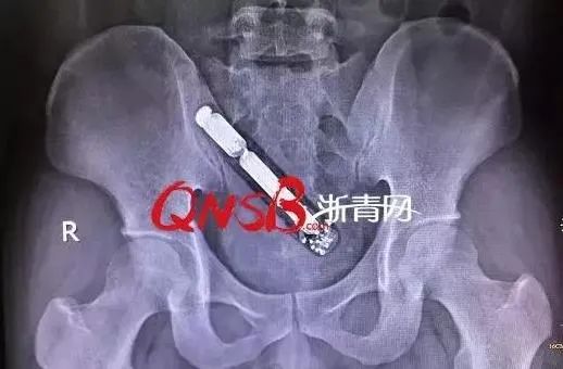灯泡,哑铃,活泥鳅,医生呼吁:别再往肛门里塞东西了