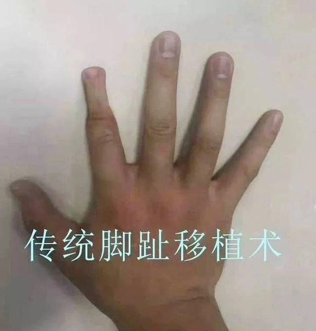 全球排名第一的手指再造案例,看后让人惊叹