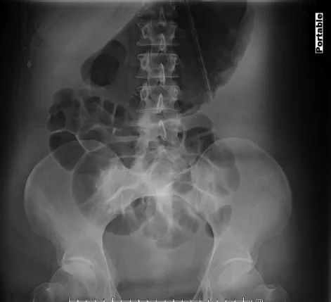 腹部x影像证实存在明显的胃胀气以及肠梗阻(图4).