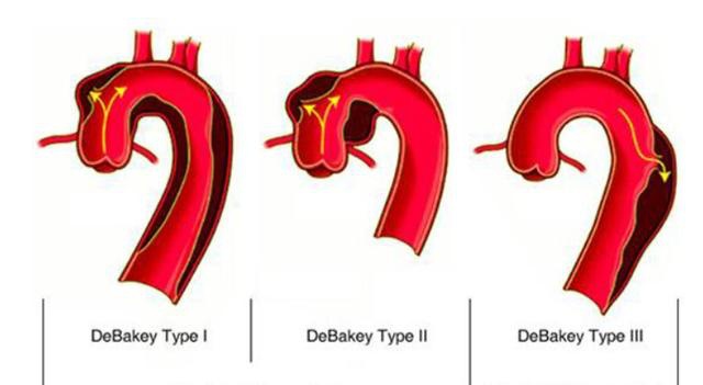 a型(相当于debakey i型和Ⅱ型)指剥离部位累及升主动脉,也可延及降主