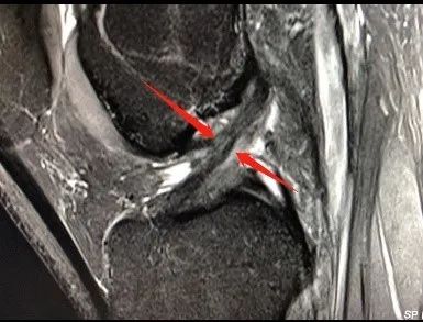 受伤后35天,磁共振复查,结果提示 前交叉韧带部分撕裂,连续性存在