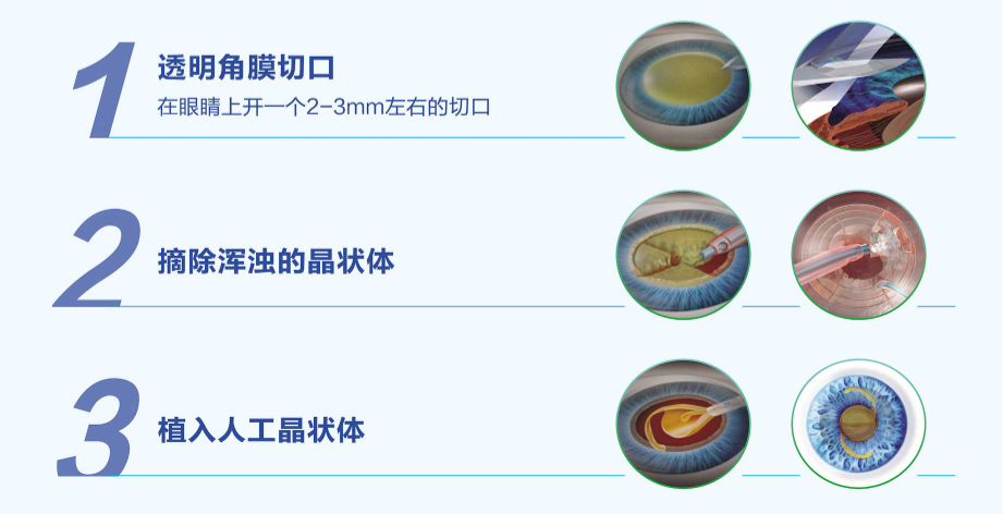 爱尔科普白内障有特效药醒醒吧