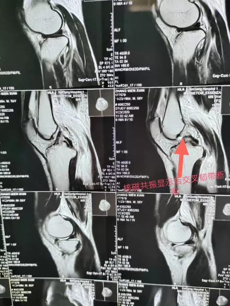 河南圣德医院骨二科成功完成一例膝关节镜下后交叉韧带重建