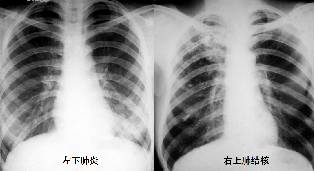 新冠肺炎诊断为何要看重影像诊断?影像分析如何展开?