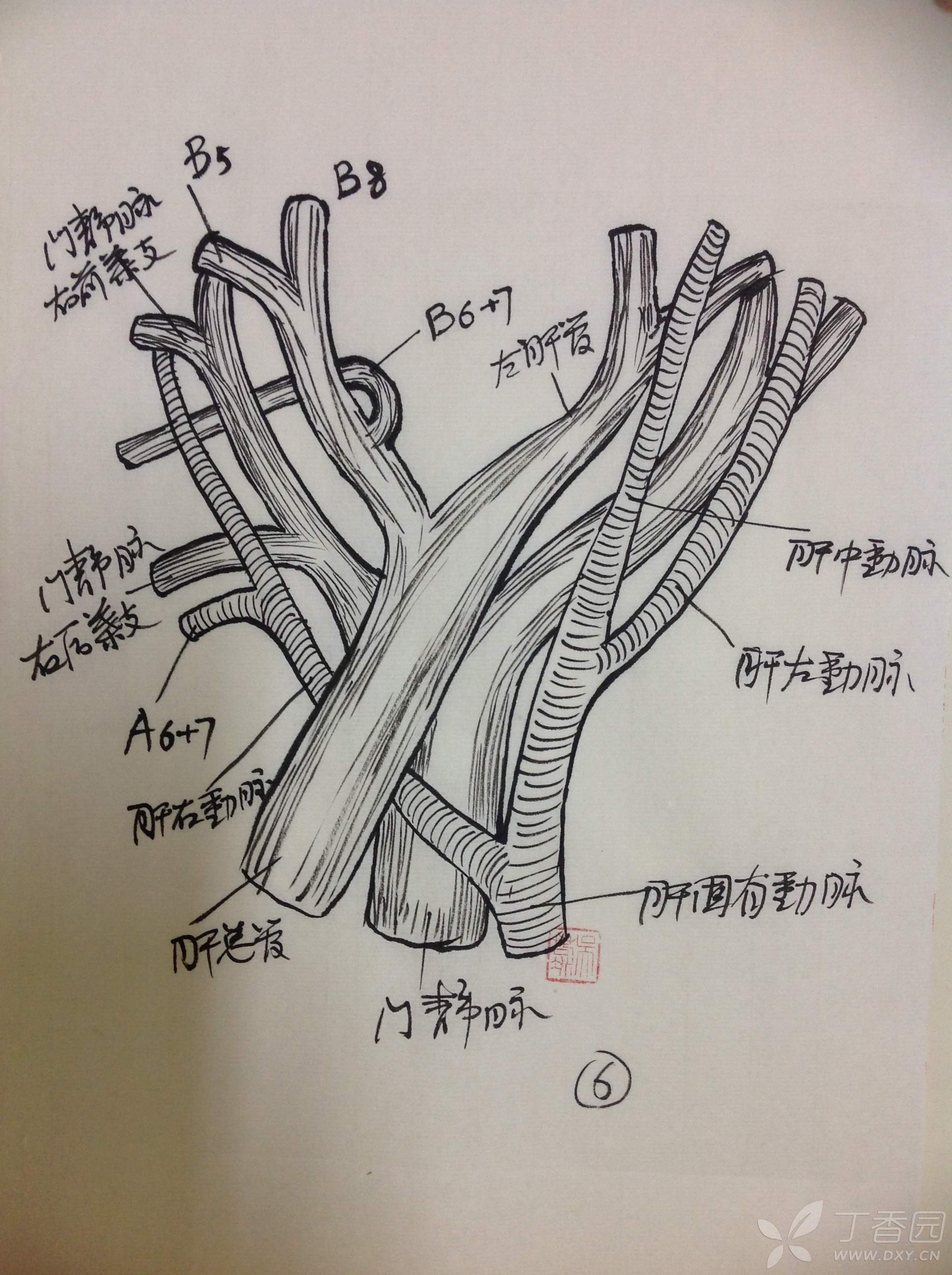 42,胆总管囊肿手术(手绘图)