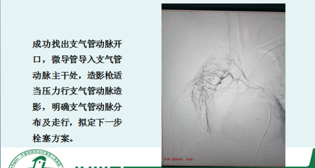 宁夏第四人民医院成功为一名大咯血患者实施支气管动脉栓塞术