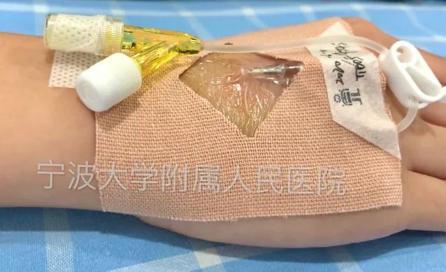 安全又牢固的"窗口贴"固定留置法,视频讲解来了