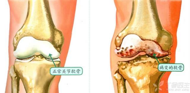 腿越来越弯,膝盖越来越痛,这是怎么回事?该怎么办?