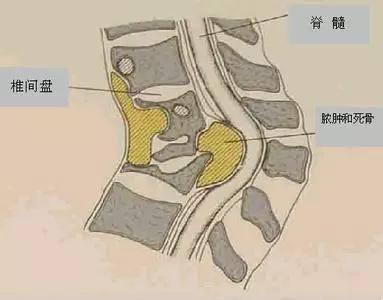 如果诊治不当,可能导致永久性的神经功能损伤和后凸畸形,因此