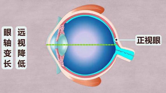 遵义目明尔来你知道眼轴在什么情况下容易过快延长