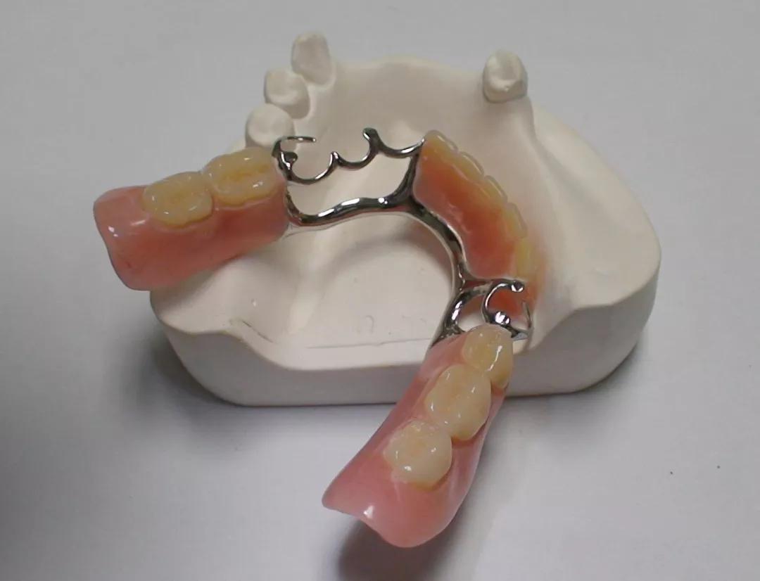 虽然活动假牙在临床上用于恢复牙齿缺失后的咀嚼功能,已经有很多年的