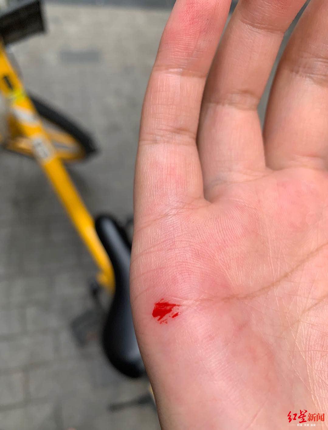 共享单车坐垫"插针"手掌被刺出血?美团:强烈谴责,将联合警方打击