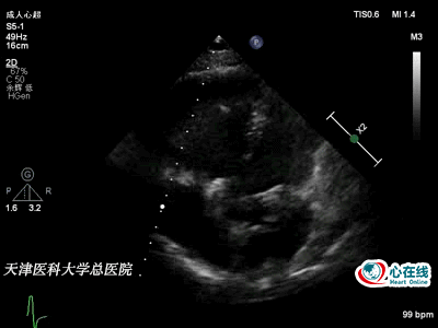 图6. 非标准的二维心尖四腔心切面示冠状静脉窦明显增宽.