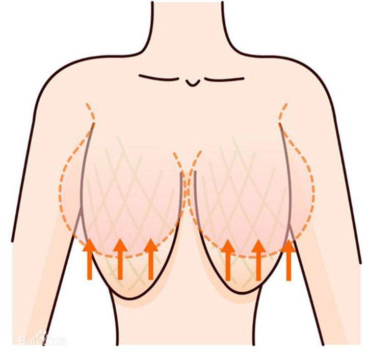 女性乳房下垂是什么情况?