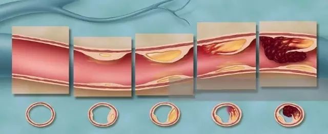 病变初期,血流通道虽无障碍,但已是危险信号;斑块如果超过血管腔的50