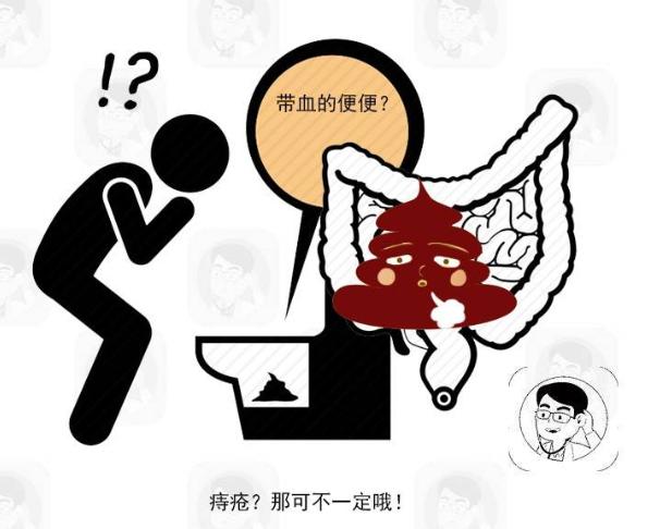 大便若出现3种迹象,暗示肠癌或已在发展中,及时做肠镜