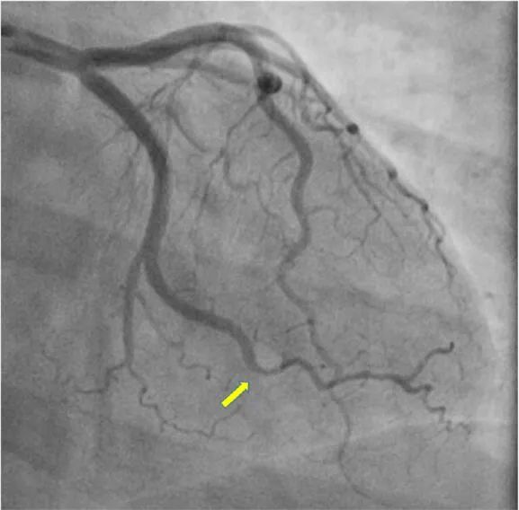 病例丨产后心绞痛一例,冠脉夹层还是急性心梗?