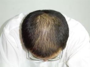 脂溢性脱发患者多久洗一次头发?该如何洗发呢?__凤凰网