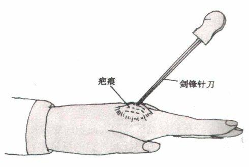 针灸说针刀疗法