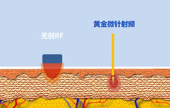 抗衰选热玛吉还是黄金微针?看老司机全面解读!_凤凰网