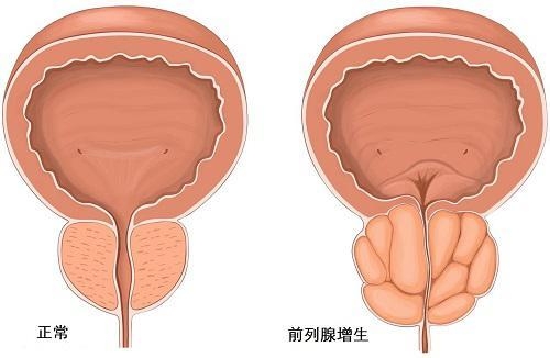 神麻贡品如何拯救男性前列腺增生按摩只是第一步