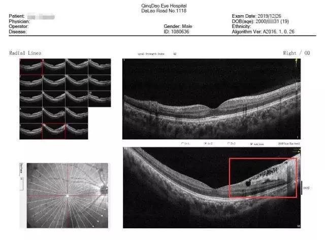 眼底oct显示:右眼视网膜劈裂